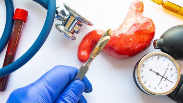 Sleeve Surgery Success